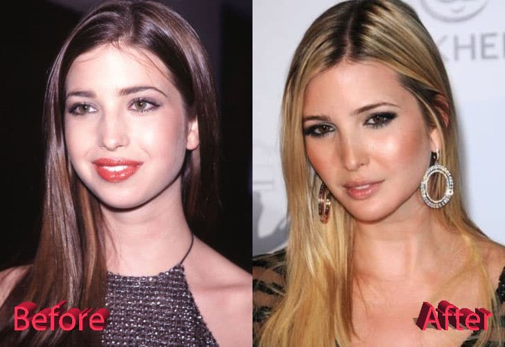 Ivanka Before And After Plastic Surgery