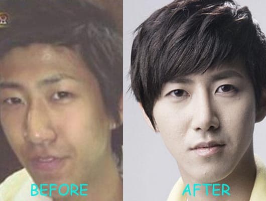 Kwanghee Plastic Surgery Before 1