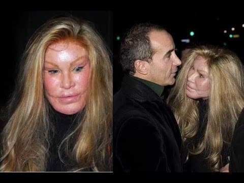 Lion Lady Plastic Surgery Before And After 1