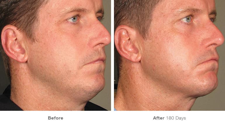 Plastic Surgery For Acne Scars Before And After 1