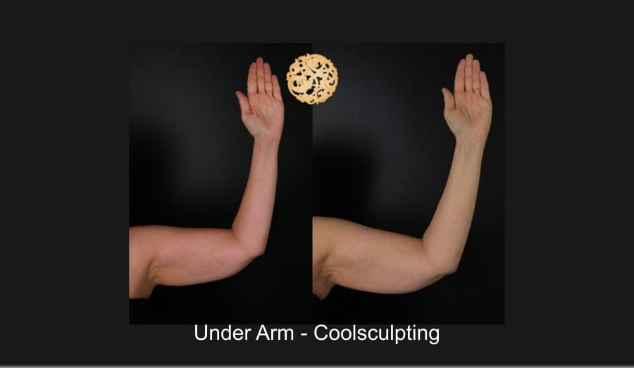 Plastic Surgery On Arms Before And After 1