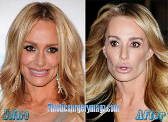 Taylor Armstrong Before Plastic Surgery 1