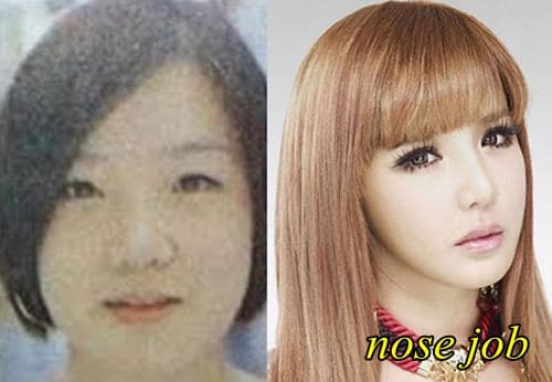 2Ne1 Before And After Plastic Surgery 1