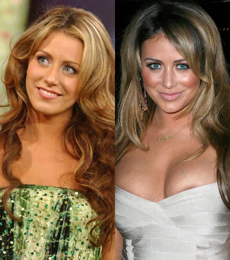 Aubrey O Day Plastic Surgery Before And After 1