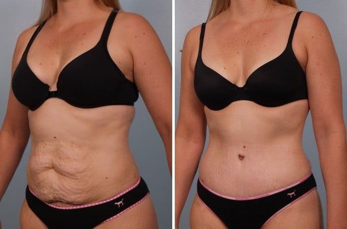 Before And After Plastic Surgery Breast 1