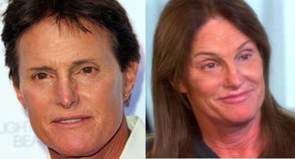 Caitlyn Jenner Before And After Plastic Surgery 1