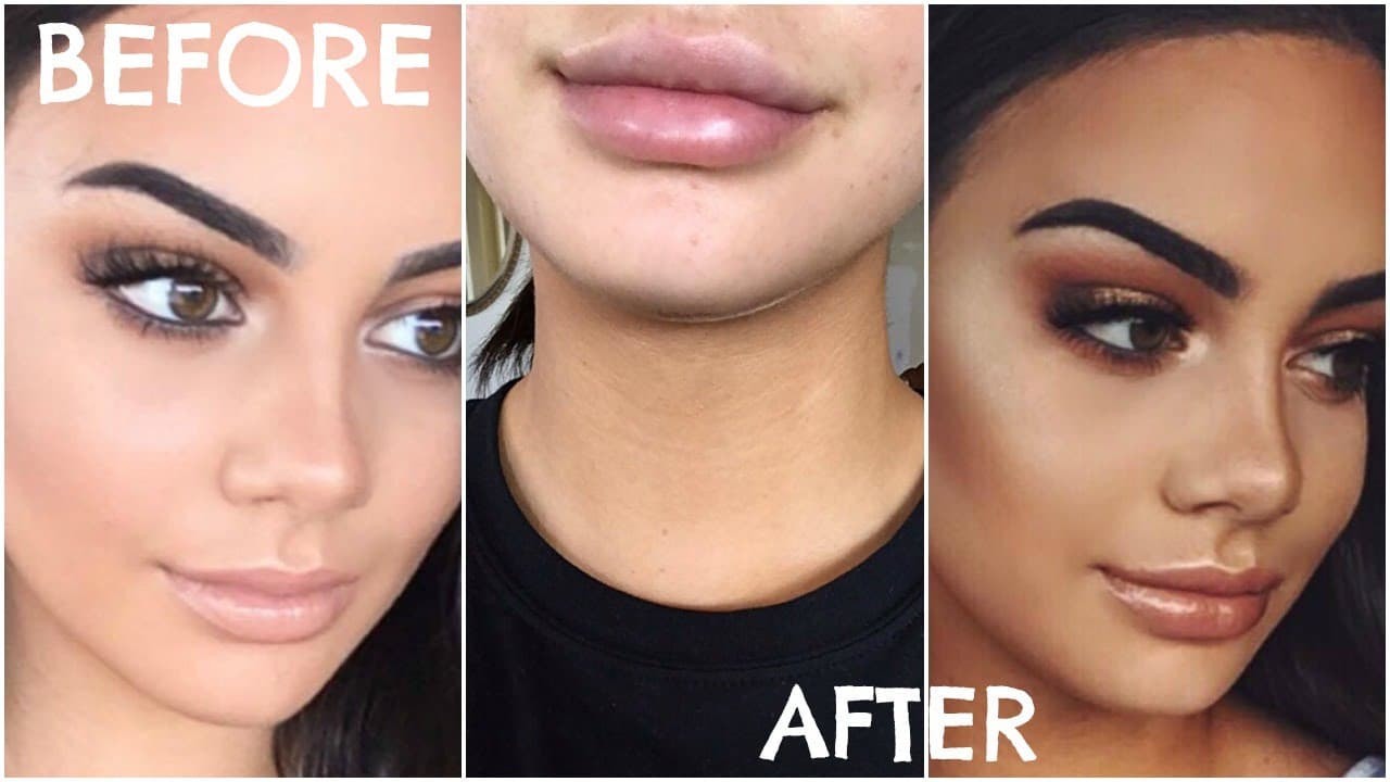 Kylie Jenner Before And After Plastic Surgery Pictures 1