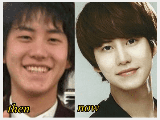 Kyuhyun Plastic Surgery Before And After 1