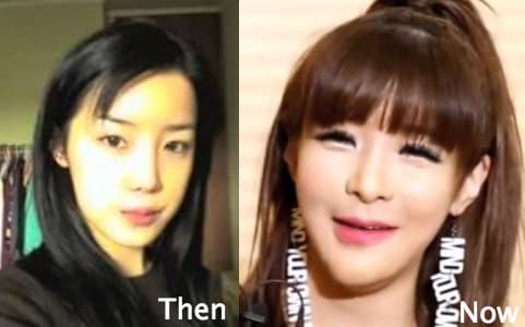 Minzy Before And After Plastic Surgery 1