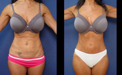 Plastic Surgery Before And After Pictures Tummy Tuck 1