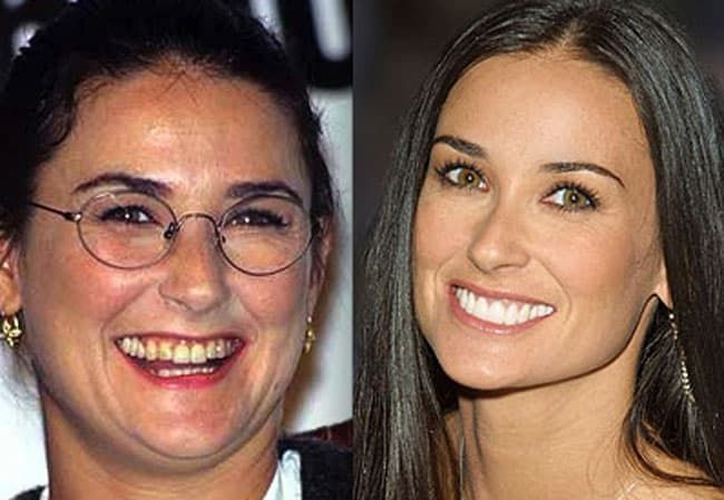 Plastic Surgery Of Hollywood Stars Before And After 1