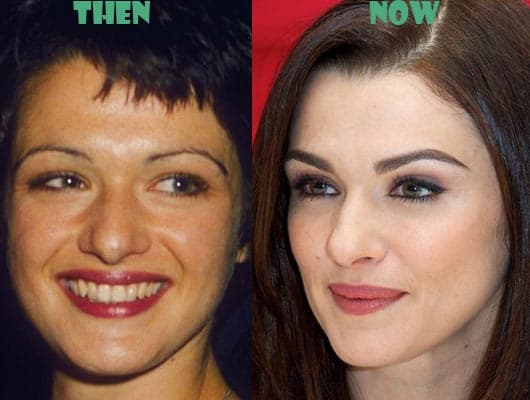 Rachel Weisz Plastic Surgery Before And After 1