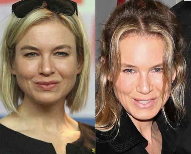 Renee Zellweger Plastic Surgery Before And After Pictures 1
