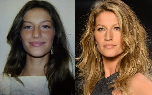 Before And After Bella Hadid Plastic Surgery 1