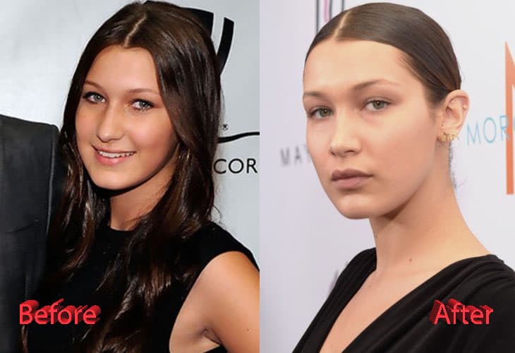 Bella Hadid Before After Plastic Surgery 1