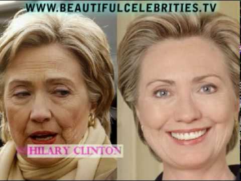 Celebrity Bad Plastic Surgery Before And After Pictures 1