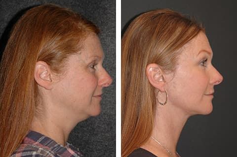 Facial Plastic Surgery Before And After Photos 1