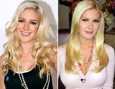 Heidi Montag Plastic Surgery Before And After Pictures 1
