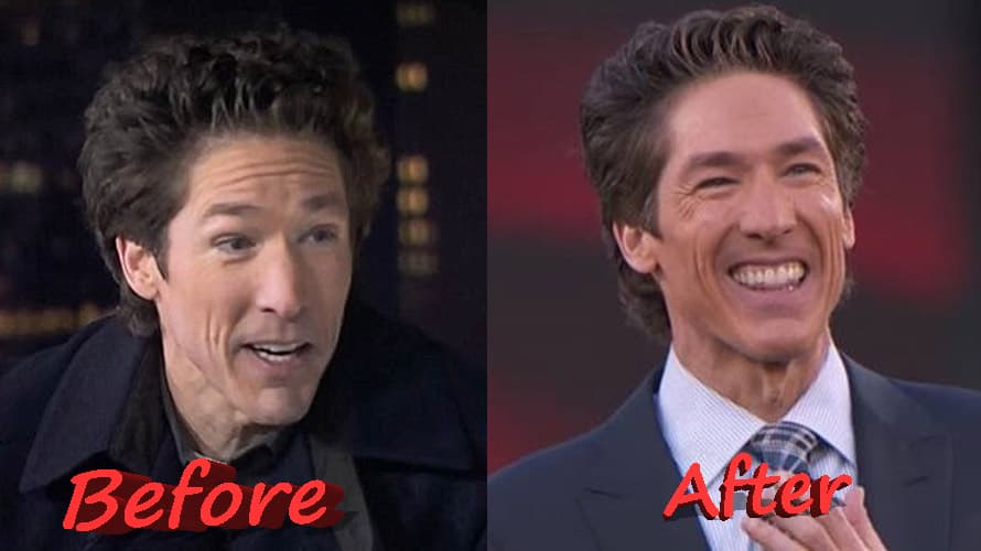 Joel Osteen Before And After Plastic Surgery 1