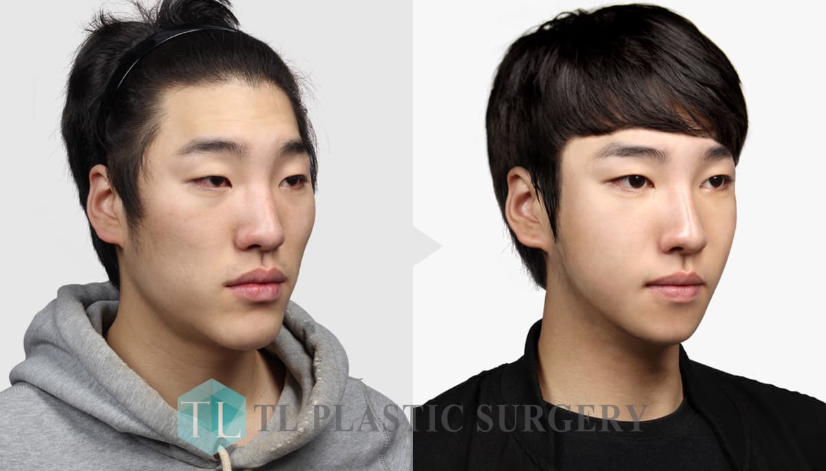 Korean Idols Before And After Plastic Surgery 1