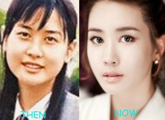 Korean Pop Stars Plastic Surgery Before And After 1
