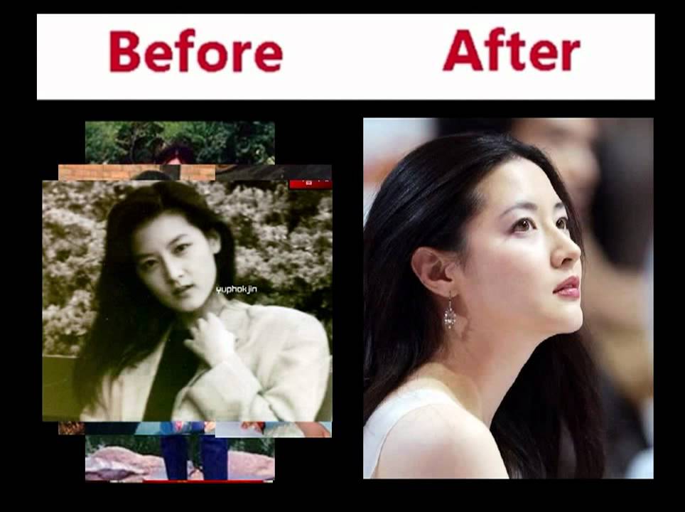 Korean Star Plastic Surgery Before And After 1