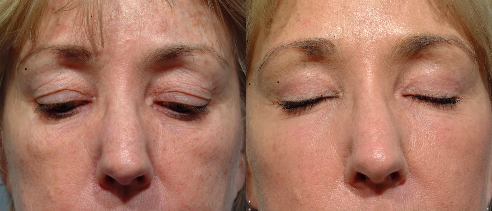 Lower Eyelid Plastic Surgery Before After 1