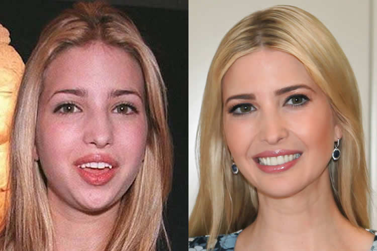 Melania Trump Before After Plastic Surgery 1