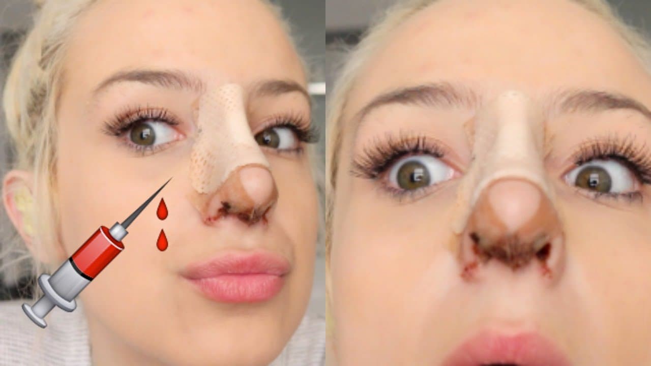 Plastic Surgery Before And After Nose Men 1