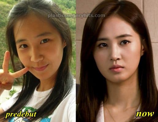 Snsd Plastic Surgery Before And After Pictures 1