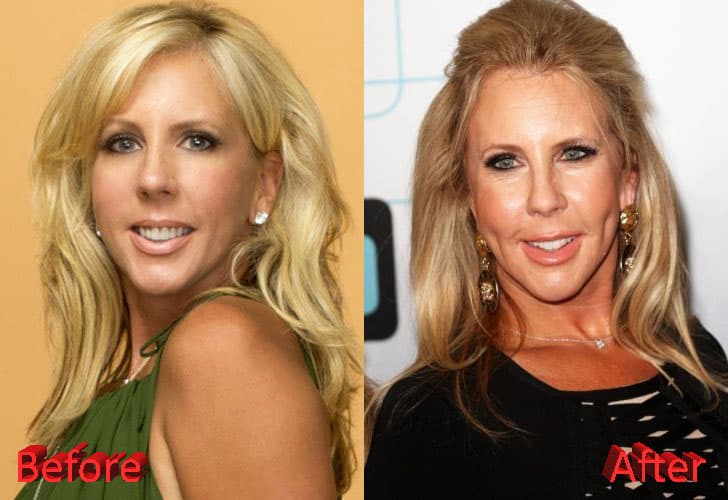 Vicki Gunvalson Nose Job Before And After Plastic Surgery 1