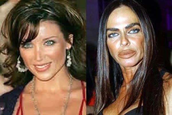 Bad Plastic Surgery Before And After Images 1