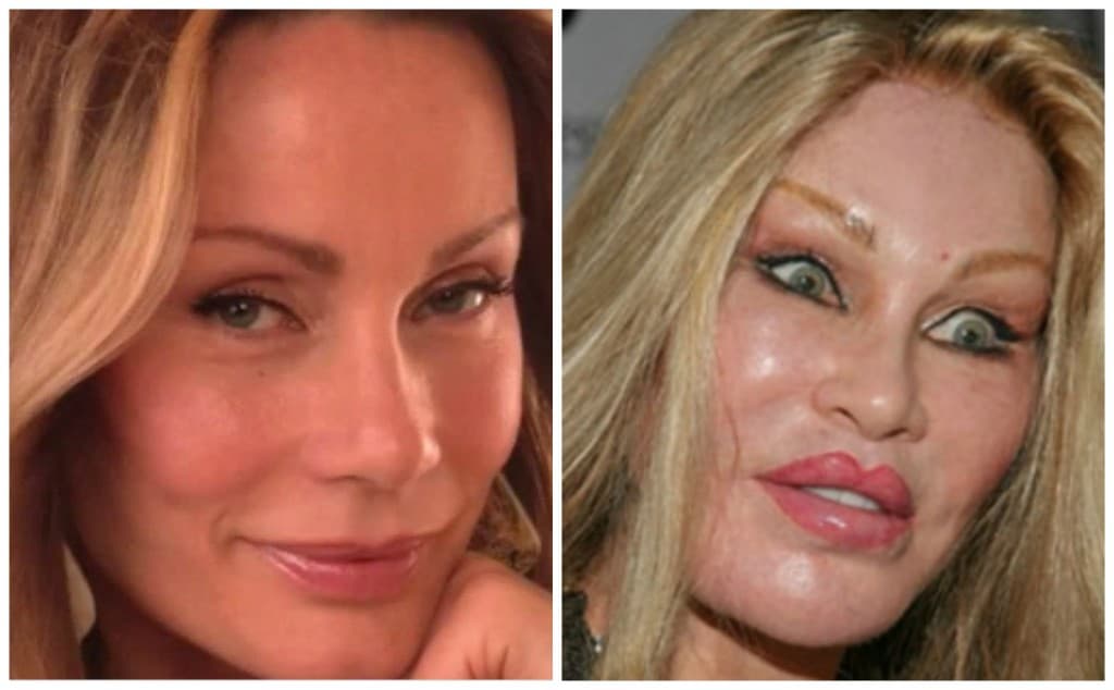 Cat Woman Before And After Plastic Surgery 1
