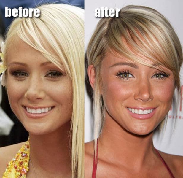 Celebrities After Plastic Surgery Before And After Pictures 1