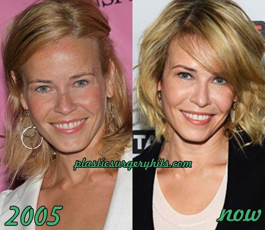 Chelsea Lately Plastic Surgery Before After 1