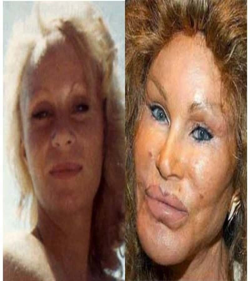 Craziest Plastic Surgery Before And After Pictures 1