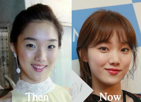 Good Before And After Plastic Surgery Eyes 1