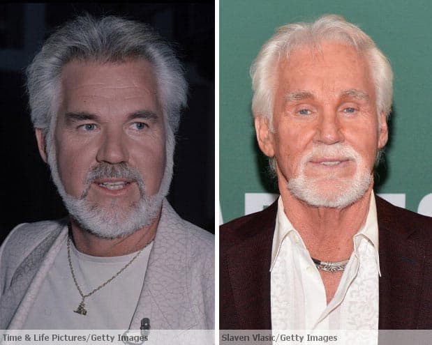 Kenny Rogers Plastic Surgery Before And After 1