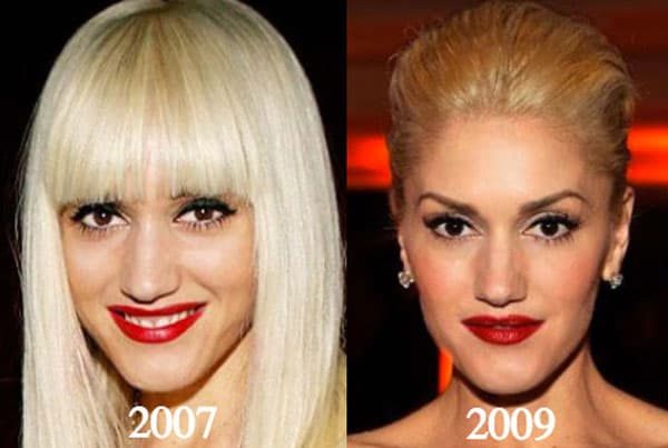 Lady Gaga Before After Plastic Surgery Pictures 1