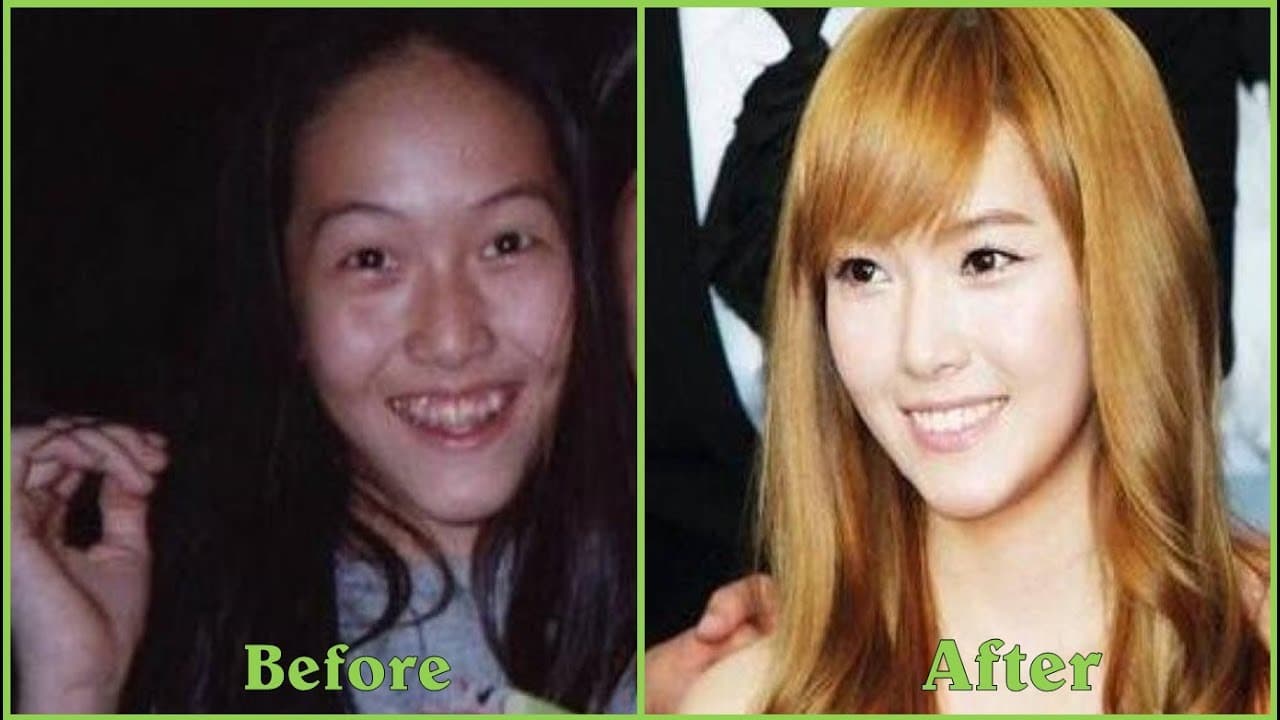 Male Kpop Plastic Surgery Before And After 1