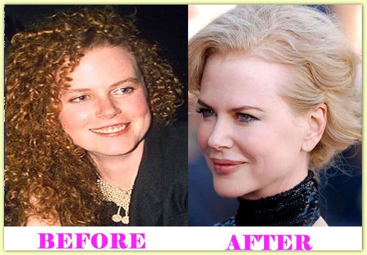 Nicole Kidman Photos Before And After Plastic Surgery 1