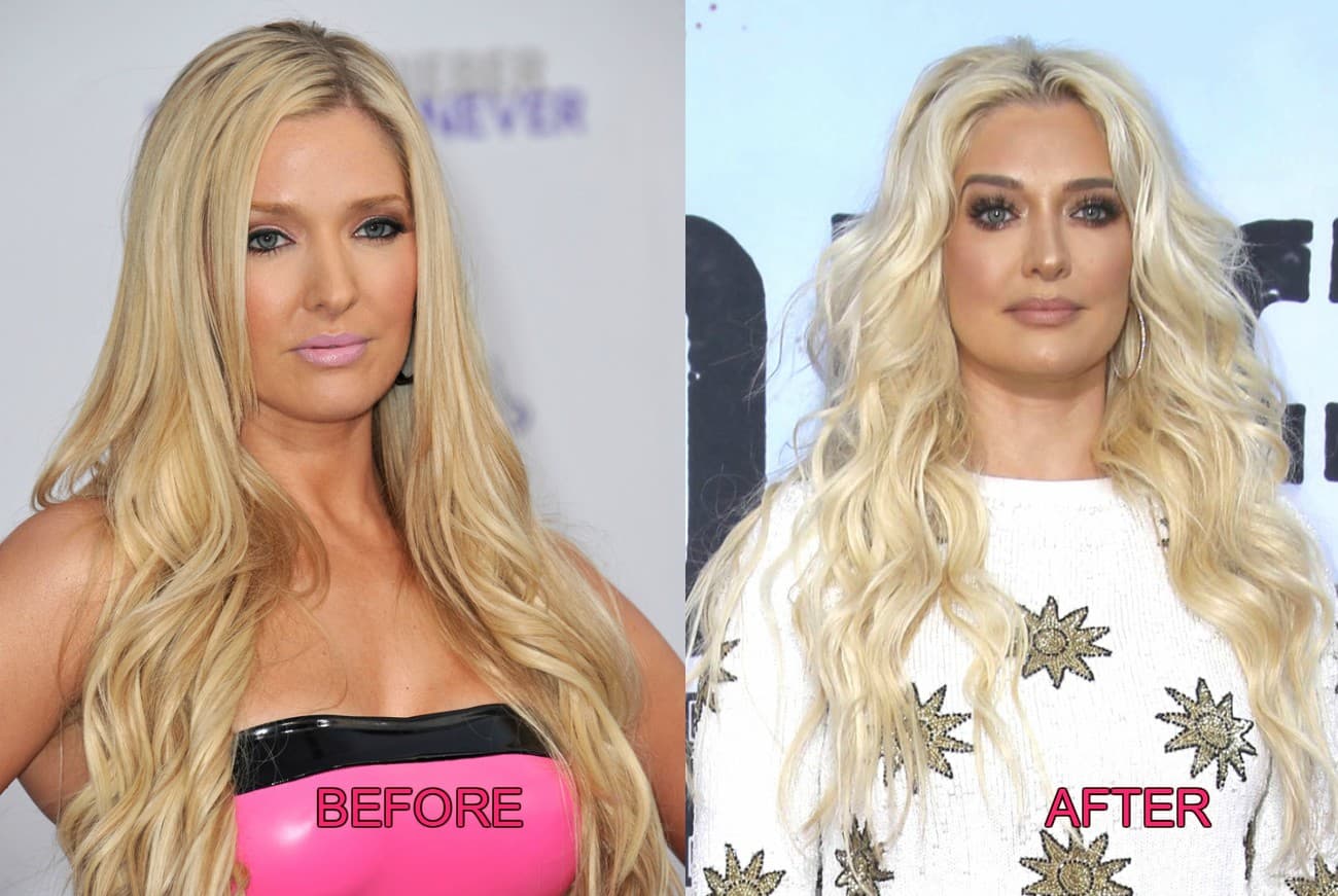 Rhobh Plastic Surgery Before And After 1