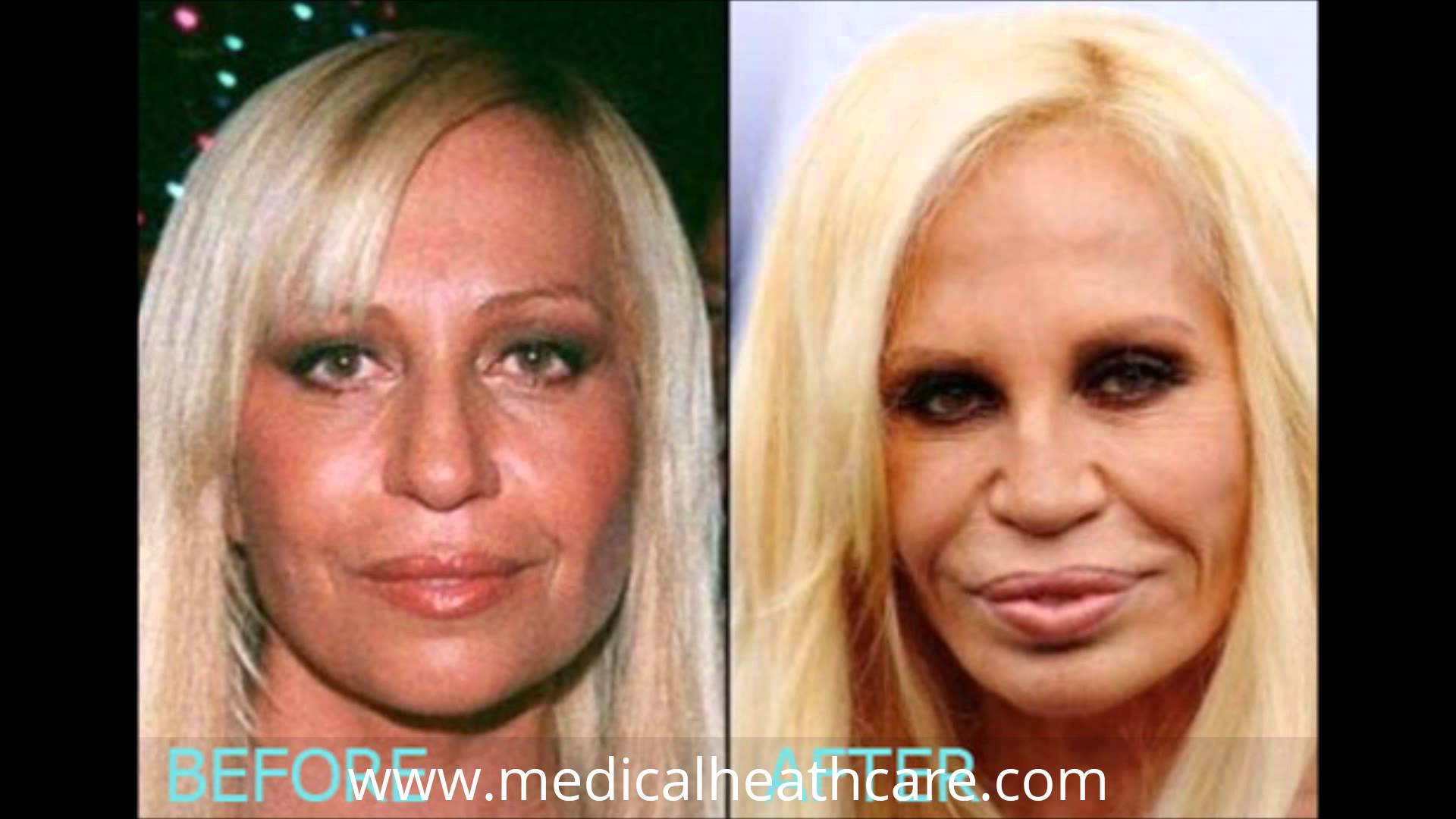 Young Donatella Versace Before Plastic Surgery 1