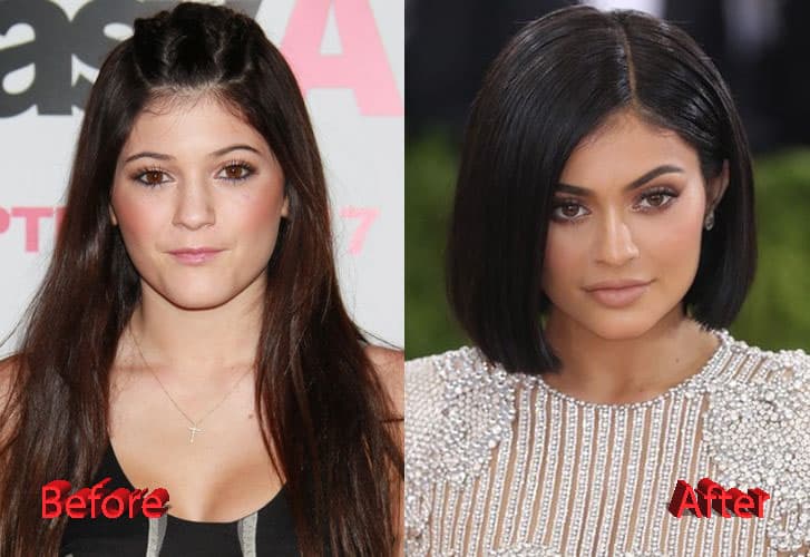 Before And After Plastic Surgery Kylie 1
