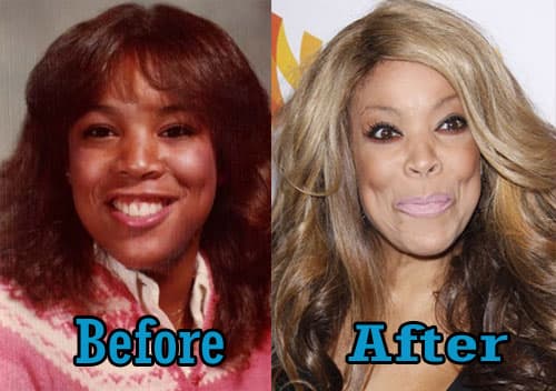 Best Plastic Surgery Hair Bald Women Pictures Before And After 1