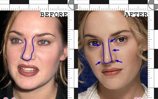 Kate Winslet Plastic Surgery And That Sucked Out Of The Face Before Now After 1