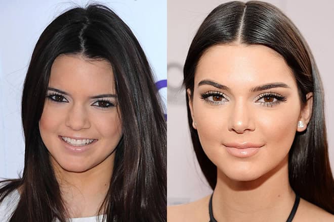 Kendell Jenner Before And After Plastic Surgery 1
