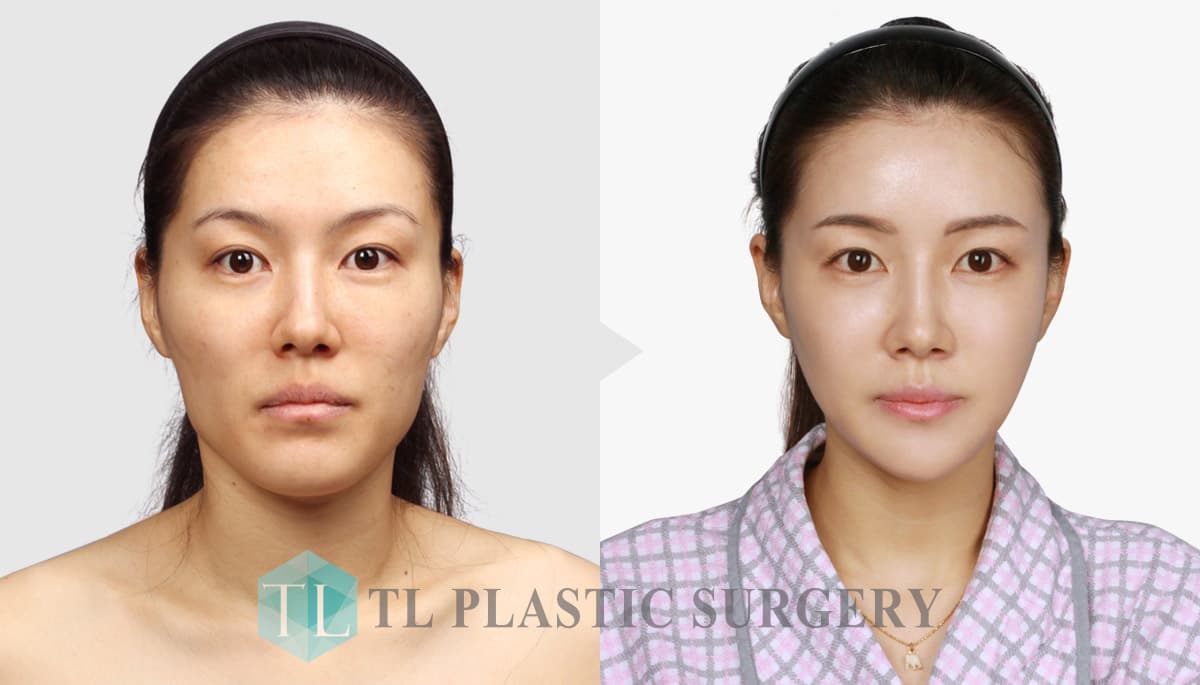 Korean Plastic Surgery Before After 2016 1