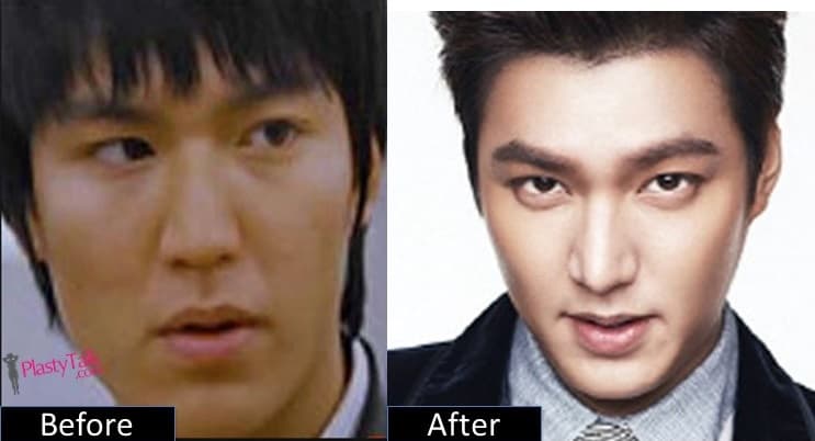 Korean Plastic Surgery Before After Lee Min Ho 1