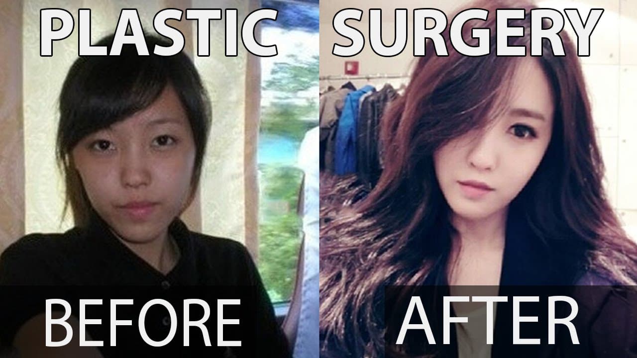Korean Plastic Surgery Before And After Kpop 1